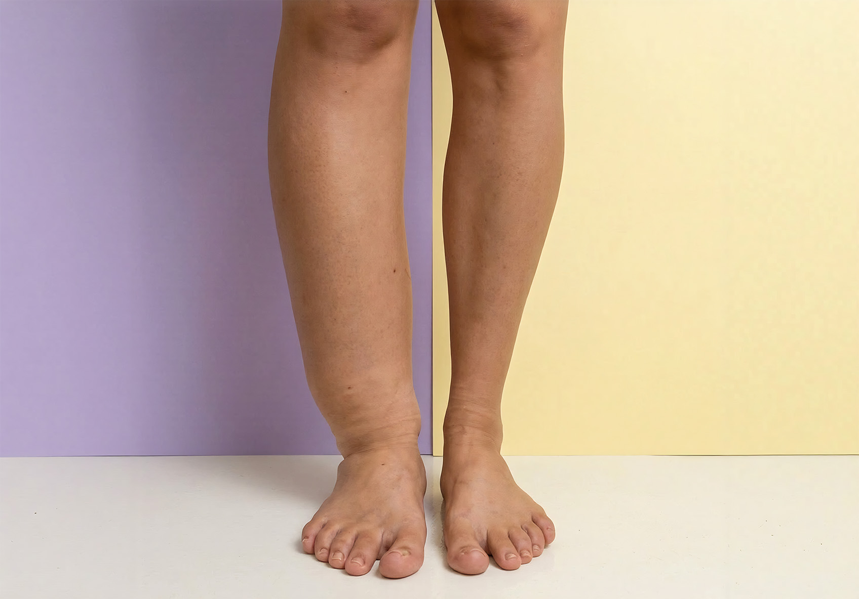 Physiotherapeutische Behandlung bei geschwollenen Beinen und Lymphstau